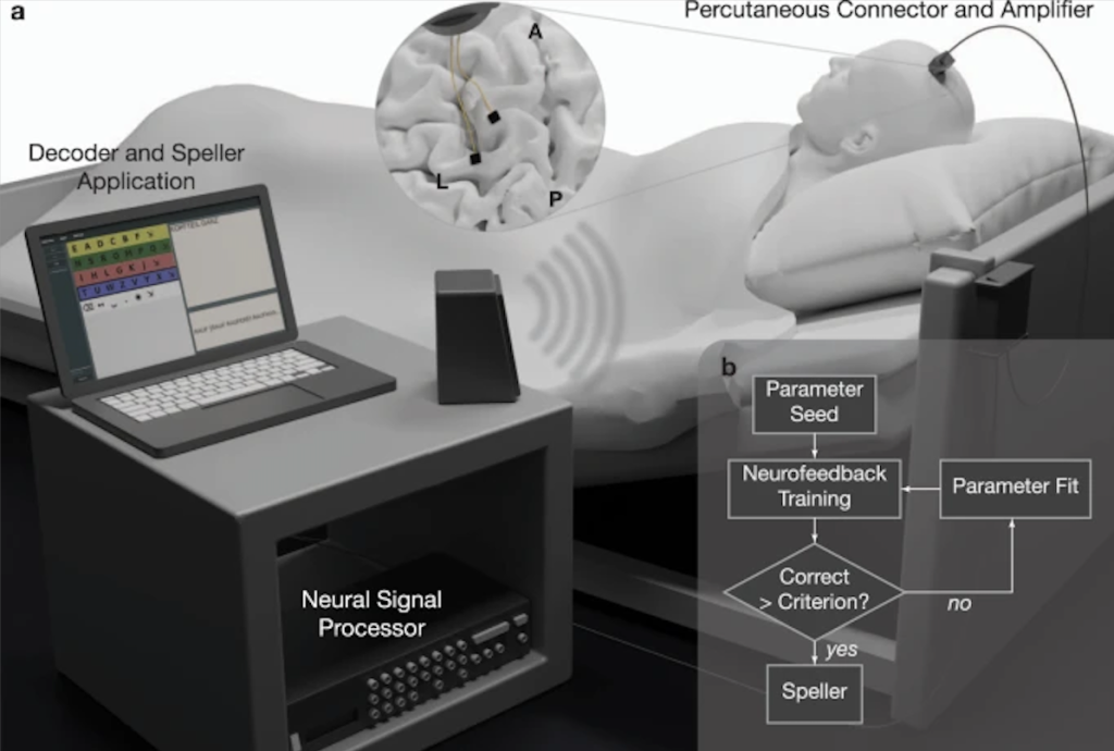 Brain Implant Enables Completely 'Locked-In' Man to Communicate Again – ScienceAlert