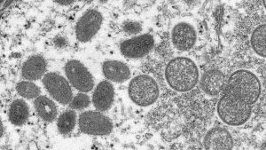 Toronto announces 1st suspected monkeypox case – CBC.ca
