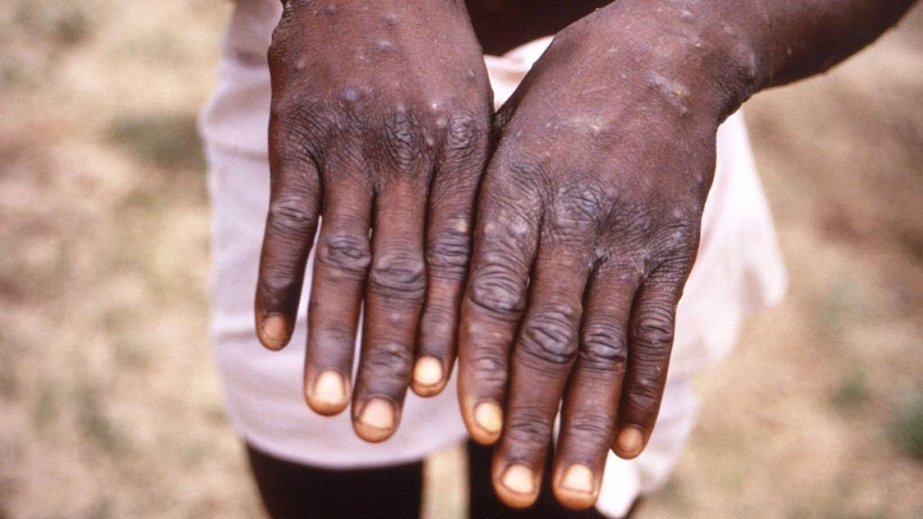 U.K. to offer smallpox vaccine shots to health workers as monkeypox spreads in Europe – CBC News