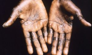 Health authorities told to remain vigilant against monkeypox – DAWN.com