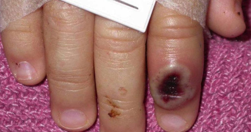 Europe, US on alert after new monkeypox cases emerge – Al Jazeera English