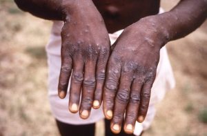 Monkeypox outbreak spreads in Europe as U.K., Portugal confirm cases – CBC News Monkeypox outbreak spreads in Europe as U.K., Portugal confirm cases – CBC News