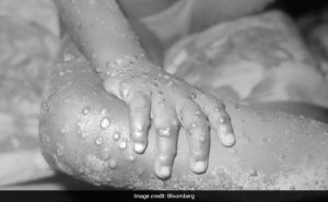 Monkeypox Spreads To 19 Countries: All You Need To Know – NDTV