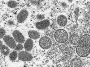 Monkeypox questions and answers from Alberta experts after one case found in the province – Sherwood Park News Monkeypox questions and answers from Alberta experts after one case found in the province – Sherwood Park News