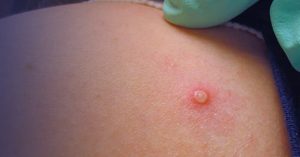 Monkeypox Reaches Texas – Reform Austin