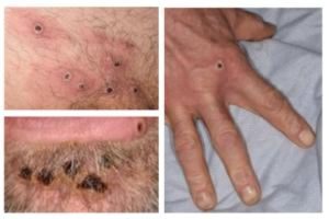 Toronto Public Health hosts 2 clinics to vaccinate against monkeypox – CBC.ca