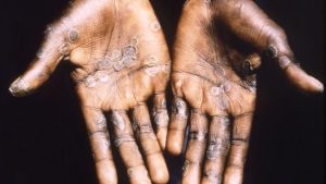 UK designates monkeypox as notifiable disease, Canada issues advisory| 5 points – Hindustan Times