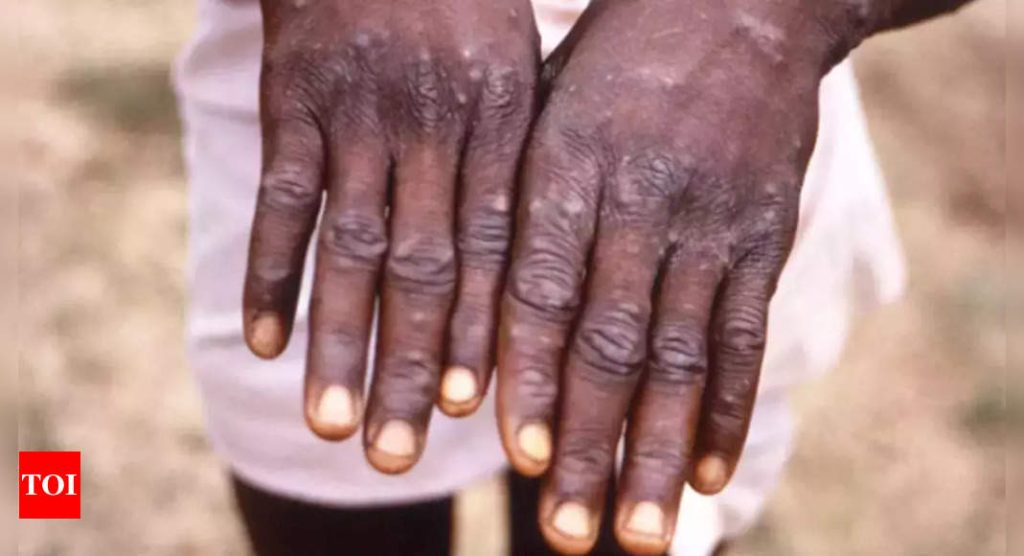 More than 700 monkeypox cases globally, 21 in US: CDC – Times of India