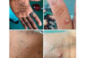 WHO calls for pressing action to contain monkeypox risk in Europe – Prensa Latina
