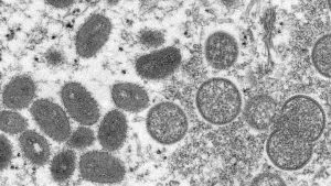 Ontario's monkeypox case count up 47 per cent in past 5 days – CTV News Toronto Ontario's monkeypox case count up 47 per cent in past 5 days – CTV News Toronto