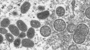 Hamilton reports first monkeypox case | CTV News – CTV News Toronto