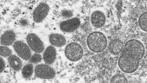 First case of monkeypox in Kingston region – CTV News Ottawa