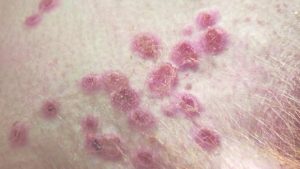 1st case of monkeypox in Sudbury area reported by health unit – CBC.ca