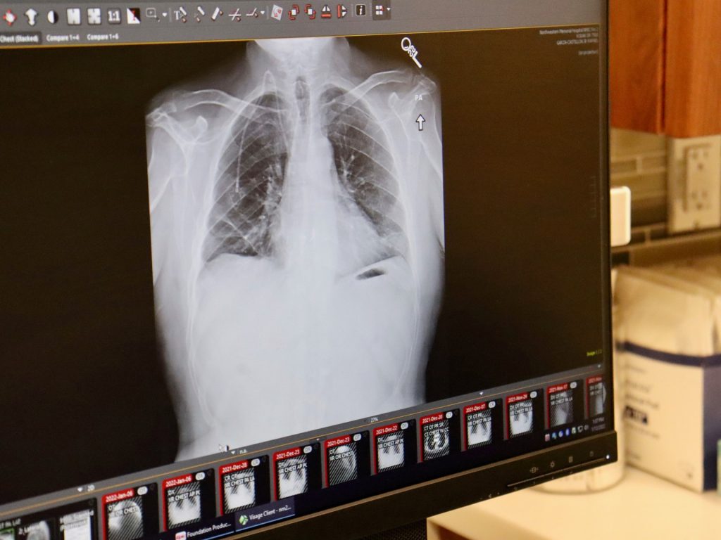 Cancer cases in people below 50 up nearly 80 percent in last three decades