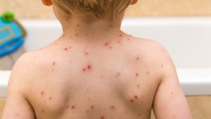 Chickenpox party at centre of B.C. small claims dispute – CTV News Vancouver