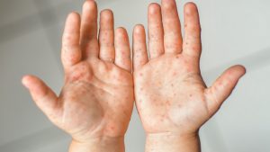 Measles identified in Ontario adult who recently travelled through Toronto Pearson airport – CTV News Toronto