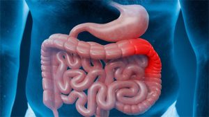 Why are young people more prone to colon cancer in India? – Daijiworld.com
