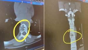 At 39 years old, this Windsor woman is battling breast cancer for a second time – CTV News Windsor