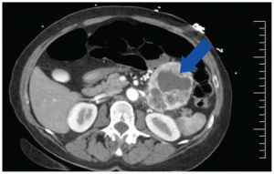 Cardiomyopathy caused by a pheochromocytoma crisis in a 66-year-old woman – CMAJ