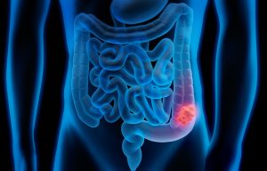 Mouth bacteria linked to colon cancer growth, says study – EasternEye – Eastern Eye