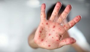 Ontario measles: Case confirmed in Halton – CTV News Toronto