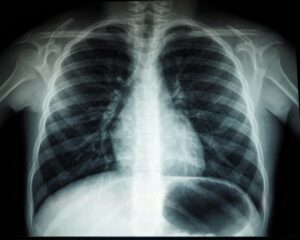 Lung Cancer Screening: Where Each Province Stands in 2026 Lung Cancer Screening: Where Each Province Stands in 2026