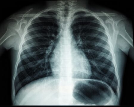 Lung Cancer Screening: Where Each Province Stands in 2026 Lung Cancer Screening: Where Each Province Stands in 2026